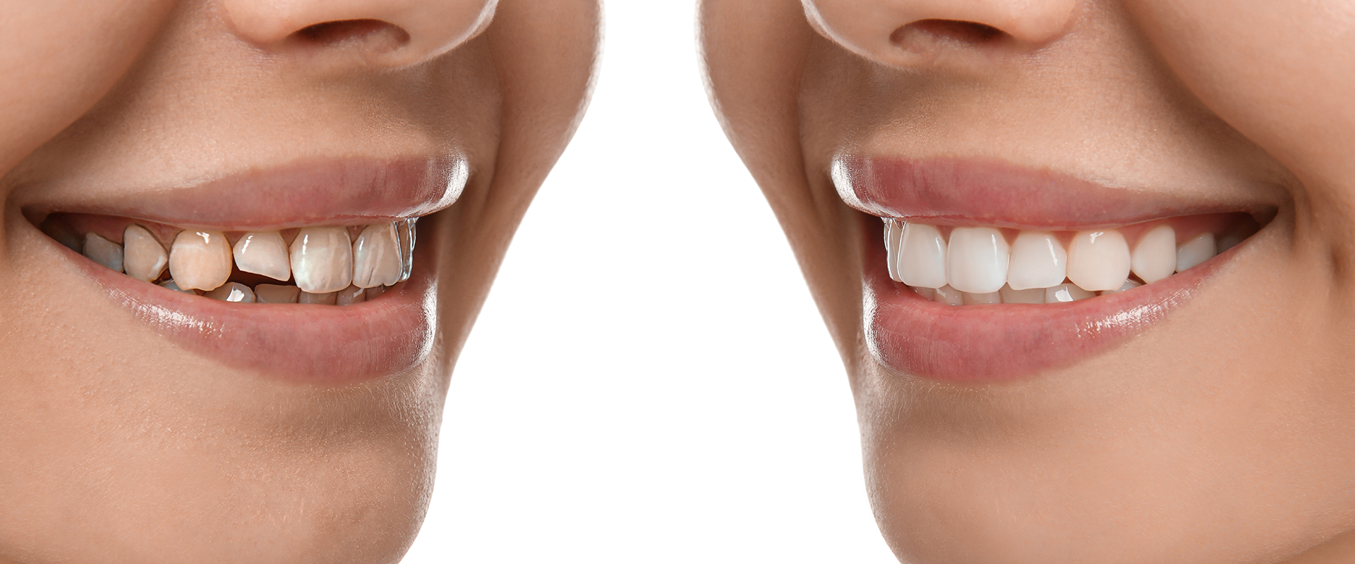 collage-with-photos-young-woman-before-after-dental-treatment-white-background-closeup-banner-design 