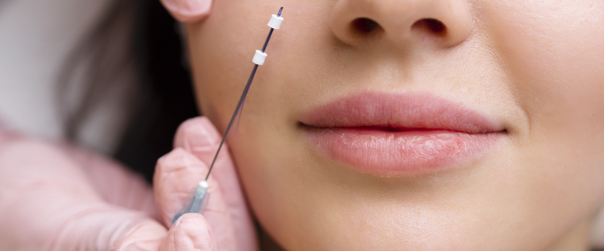 Facelift Thread lift 